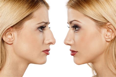 nose shaper results|Rhinoplasty Recovery Guide: Speed up Your .